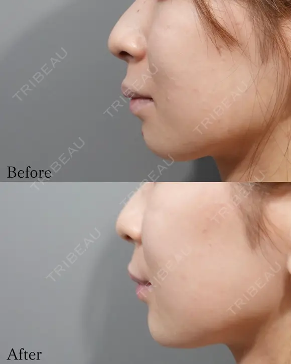 Eライン形成 before画像 メイン用