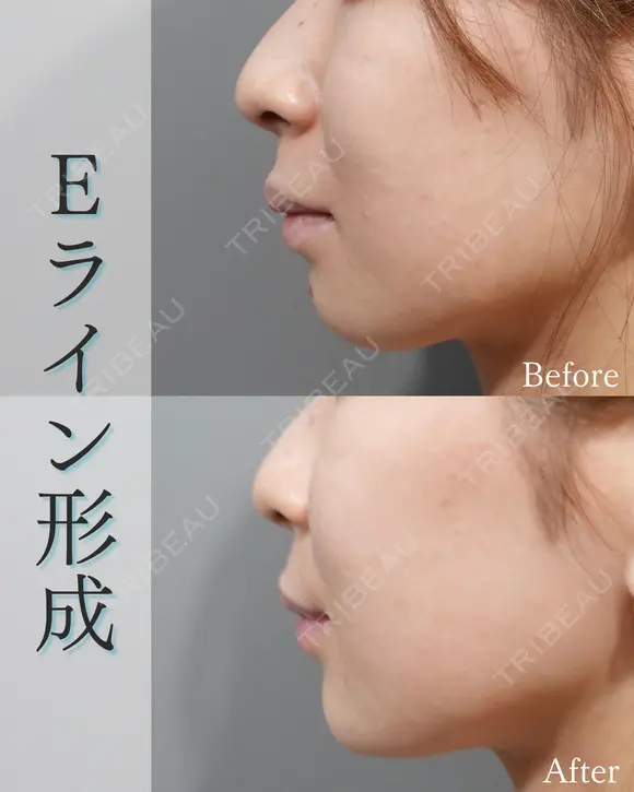 Eライン形成 after画像 メイン用