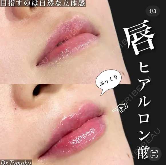 唇ヒアルロン酸 after画像 メイン用