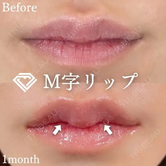 M字リップ形成術 after画像 メイン用