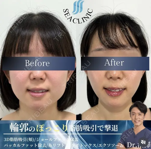 3D脂肪吸引（頬）/ジョールファット除去  /バッカルファット除去 /糸リフトエラボトックス after画像 メイン用