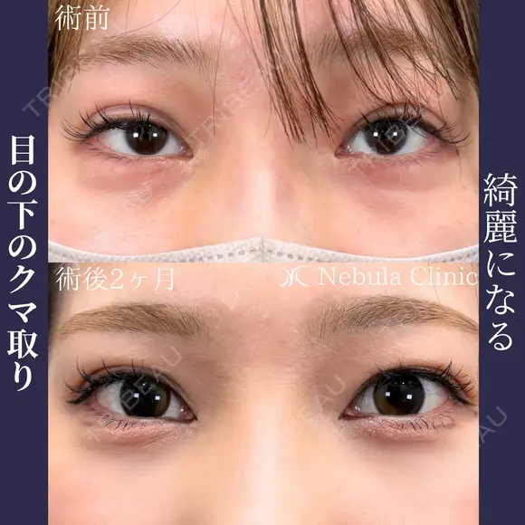 綺麗になる🦋 ネビュラクリニックの目の下のクマ取り💫 before画像 メイン用