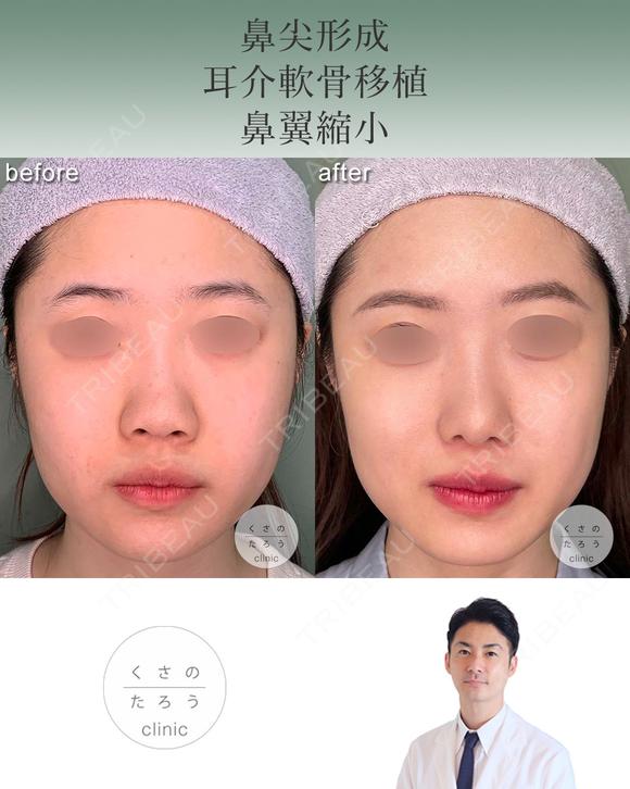 鼻尖形成+耳介軟骨移植+鼻翼縮小 before画像 メイン用