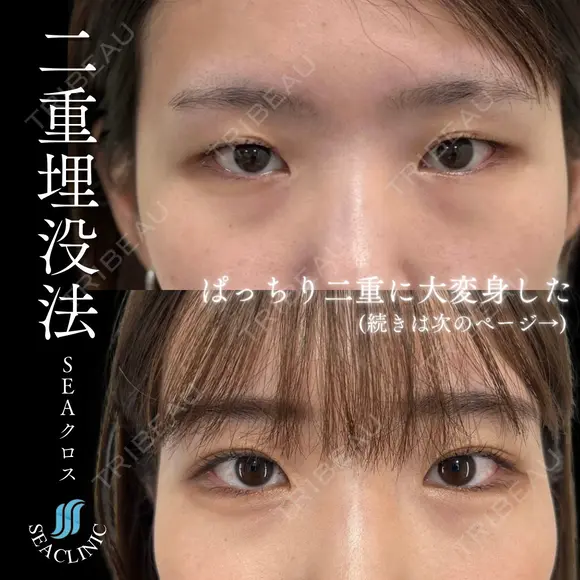 二重埋没 after画像 メイン用