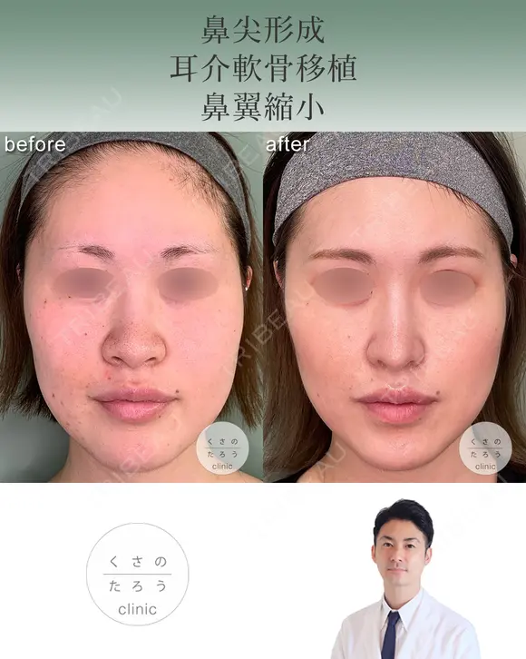 鼻尖形成+耳介軟骨移植+鼻翼縮小 before画像 メイン用