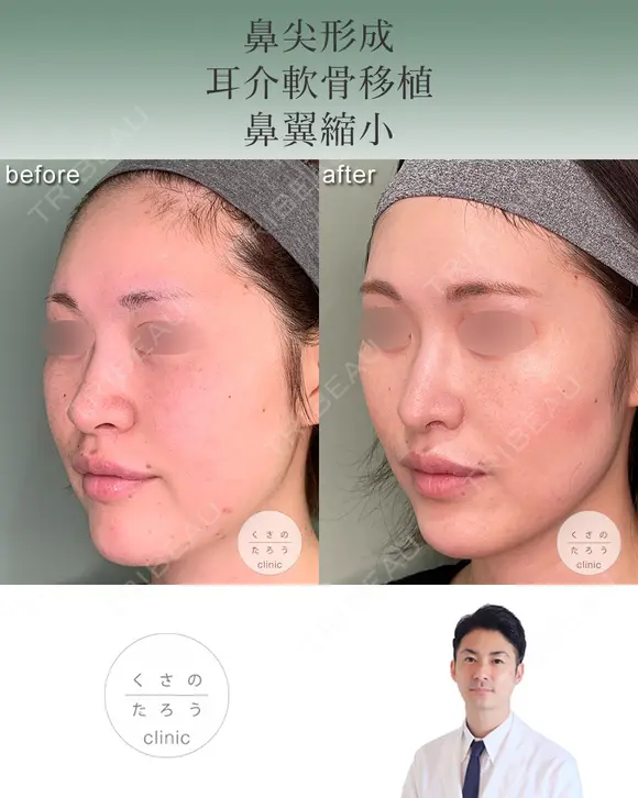 鼻尖形成+耳介軟骨移植+鼻翼縮小 after画像 メイン用