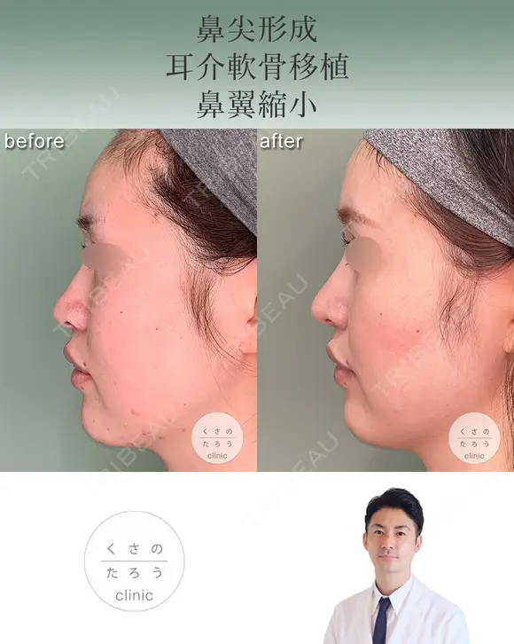 鼻尖形成+耳介軟骨移植+鼻翼縮小 after画像 メイン用