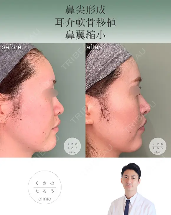 鼻尖形成+耳介軟骨移植+鼻翼縮小 after画像 メイン用