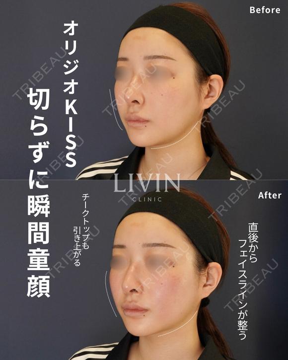 オリジオKISS両頬＋フェイスライン400shot before画像 メイン用