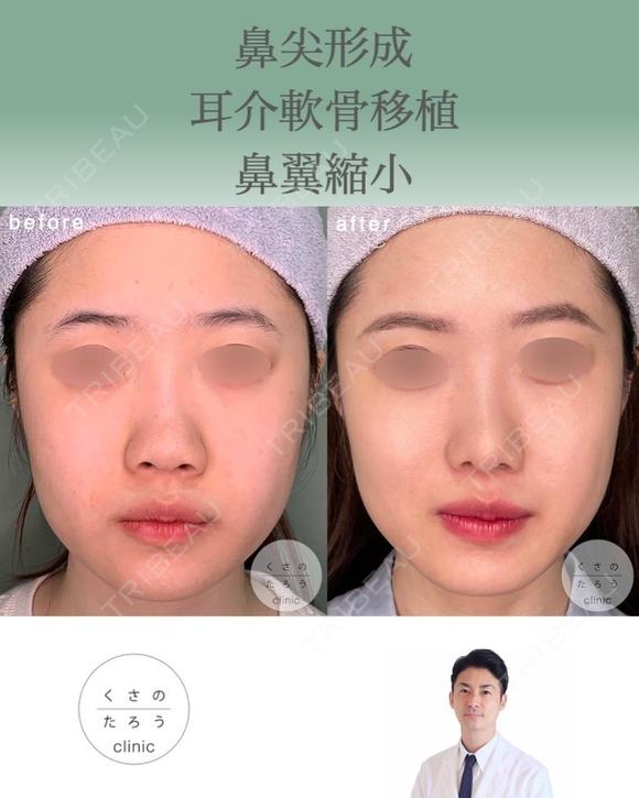 鼻尖形成+耳介軟骨移植+鼻翼縮小 after画像 メイン用