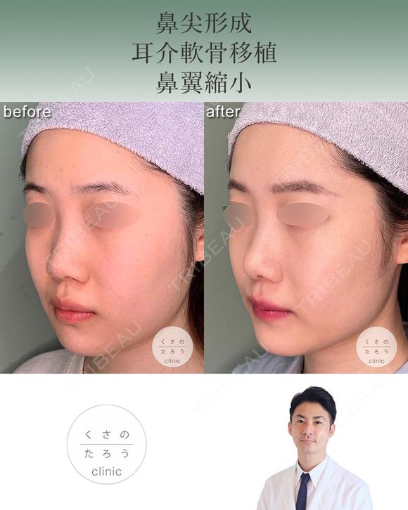 鼻尖形成+耳介軟骨移植+鼻翼縮小 after画像 メイン用