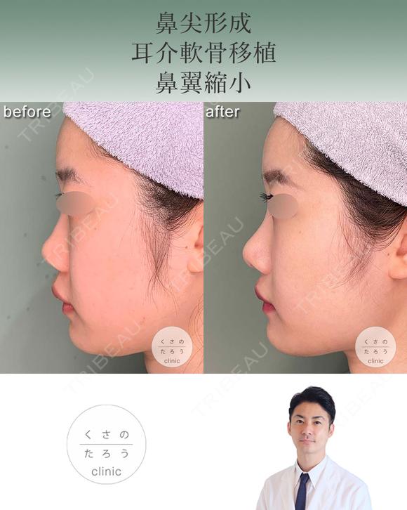 鼻尖形成+耳介軟骨移植+鼻翼縮小 after画像 メイン用
