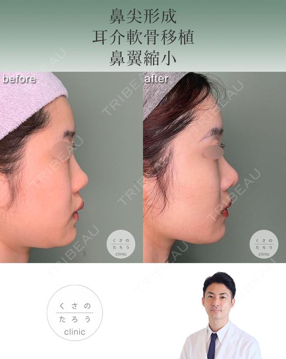 鼻尖形成+耳介軟骨移植+鼻翼縮小 after画像 メイン用