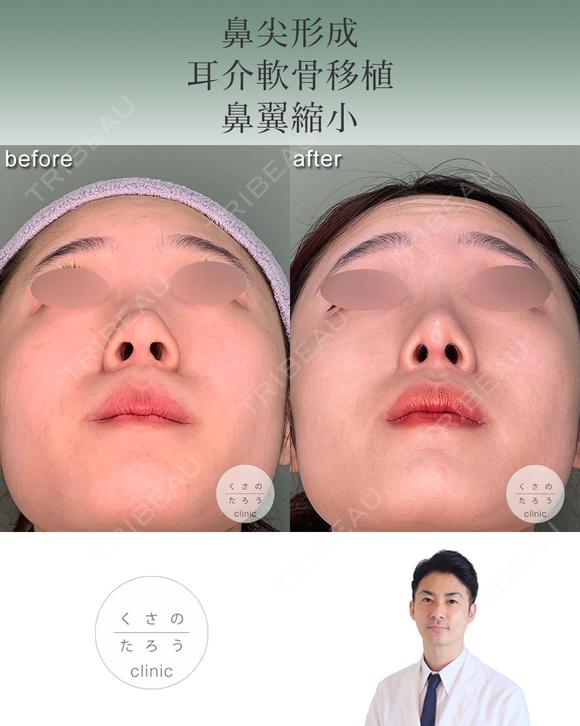 鼻尖形成+耳介軟骨移植+鼻翼縮小 after画像 メイン用
