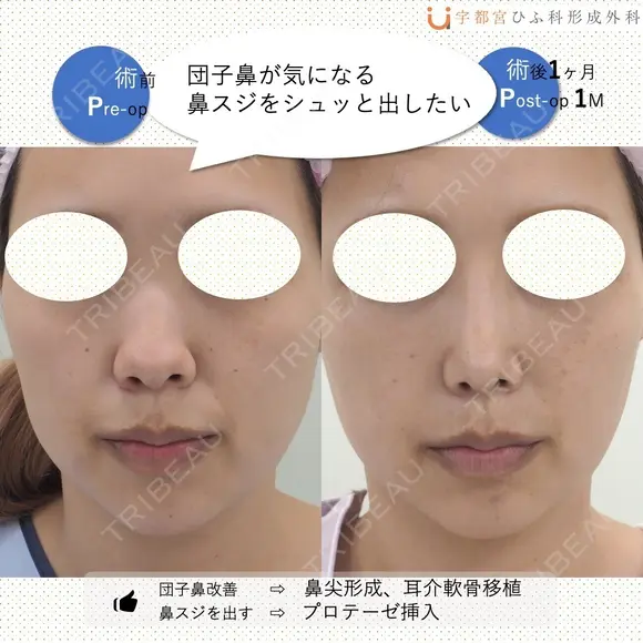 鼻フルナチュラル 30日後 メイン用