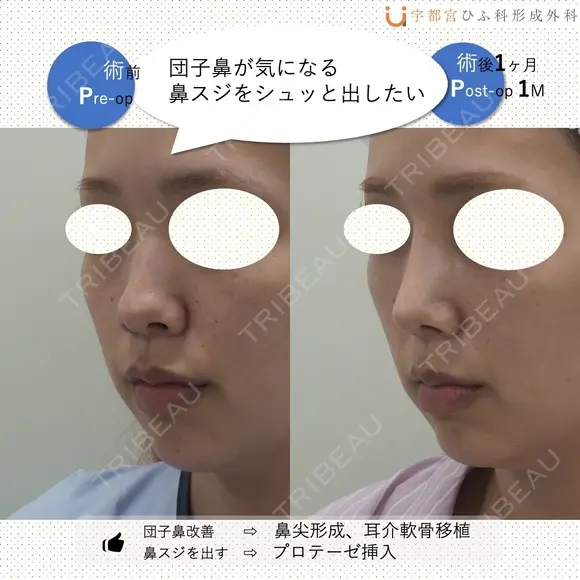 鼻フルナチュラル 30日後 メイン用