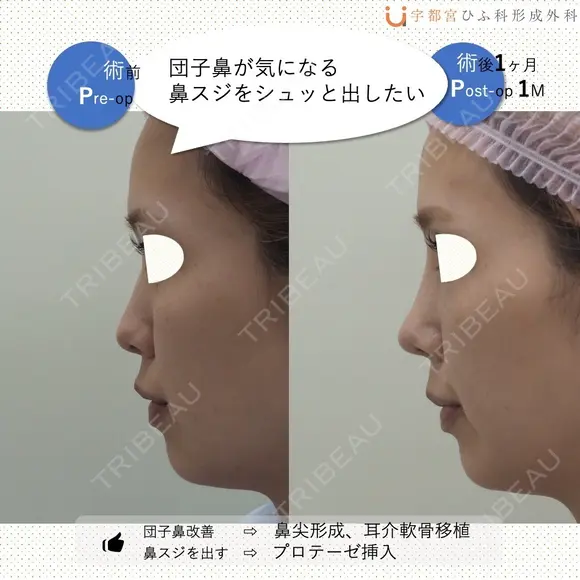 鼻フルナチュラル before画像 メイン用
