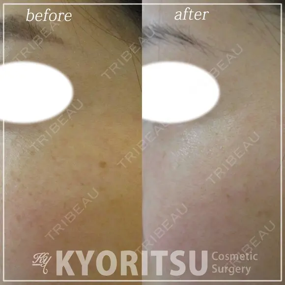 IPLフォトフェイシャル after画像 メイン用