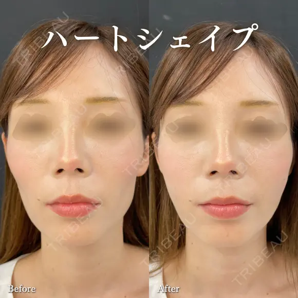 ハートシェイプ before画像 メイン用