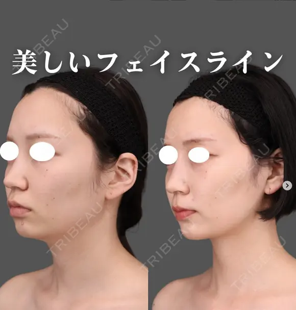 ベイザー頬＋顎下、ジョールファット脂肪吸引 after画像 メイン用