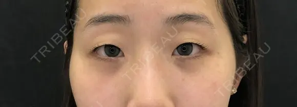 二重埋没 before画像 メイン用