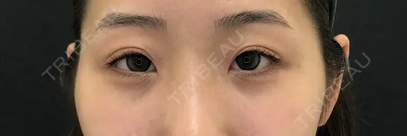 二重埋没 after画像 メイン用