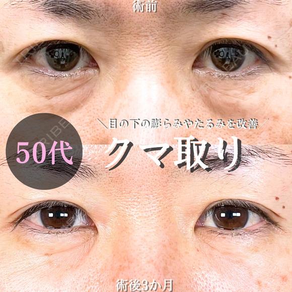 目の下のたるみ取り・クマ取り/脂肪注入(目の下・ゴルゴライン) 90日後 メイン用