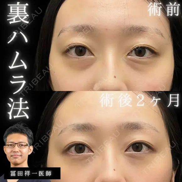 目の下のクマ治療🐻『裏ハムラ法』脂肪を移動して若々しい印象へ🌟 after画像 メイン用