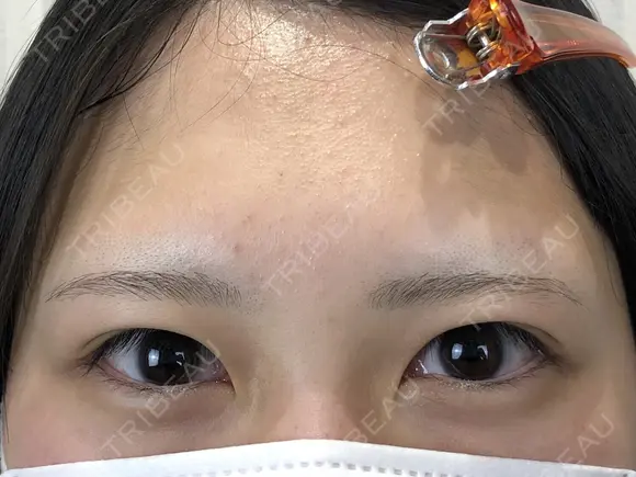 二重埋没　GOLDLONG before画像 メイン用