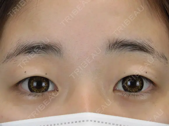 二重埋没　GOLDLONG before画像 メイン用