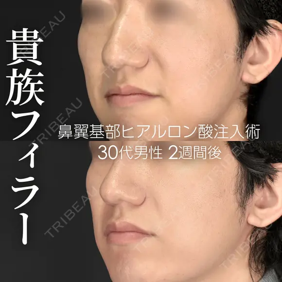 貴族フィラー （鼻翼基部ヒアルロン酸注入術） before画像 メイン用