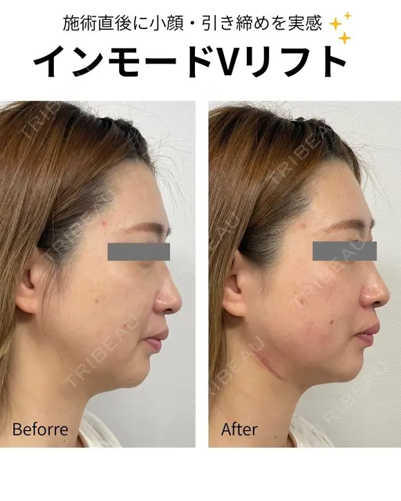 インモードVリフト before画像 メイン用