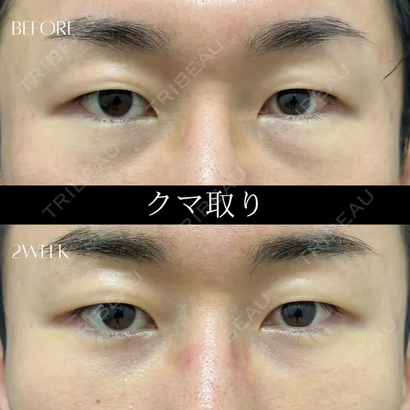目の下のふくらみ、脂肪取り（クマ取り） before画像 メイン用
