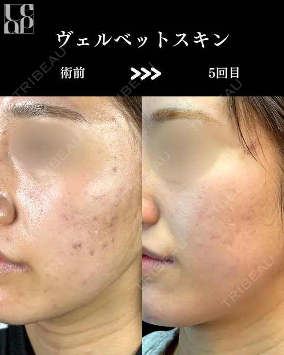 ヴェルベットスキン（ダーマペン4+マッサージピール） before画像 メイン用