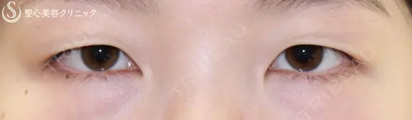 【20代女性・綺麗な二重に】二重術（埋没法）マイクロメソッド＋α（1ヶ月後） before画像 メイン用