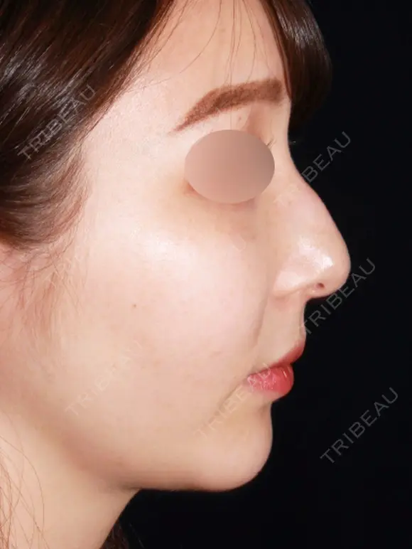 骨切りでわし鼻を卒業し理想の鼻筋に before画像 メイン用