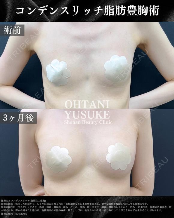 コンデンスリッチ脂肪注入豊胸 90日後 メイン用