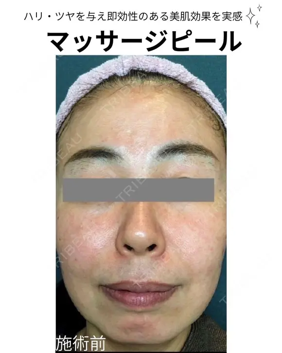 マッサージピール before画像 メイン用