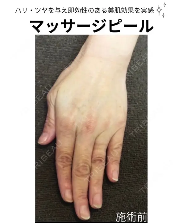 マッサージピール before画像 メイン用