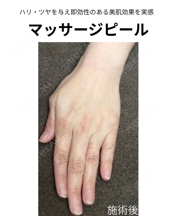 マッサージピール after画像 メイン用