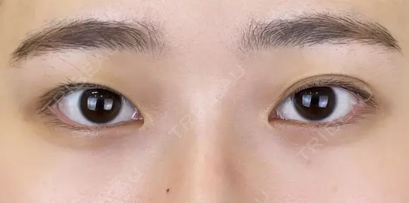 二重埋没法 before画像 メイン用
