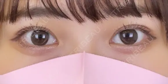 二重埋没法 30日後 メイン用