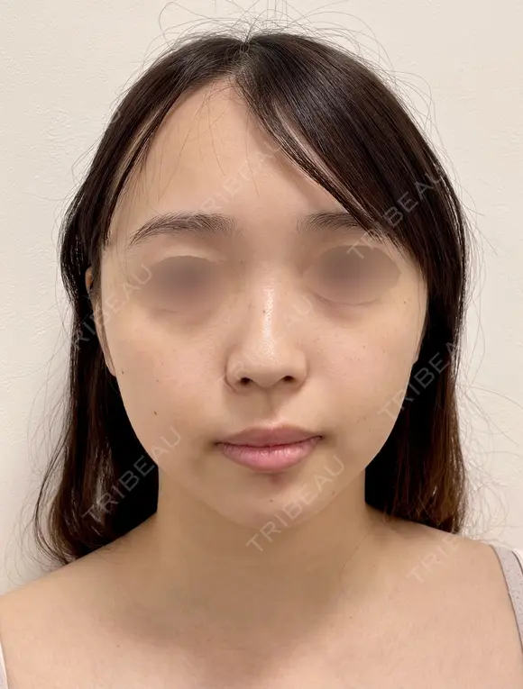 SEAライン ‐３D脂肪吸引（頬・顎） before画像 メイン用