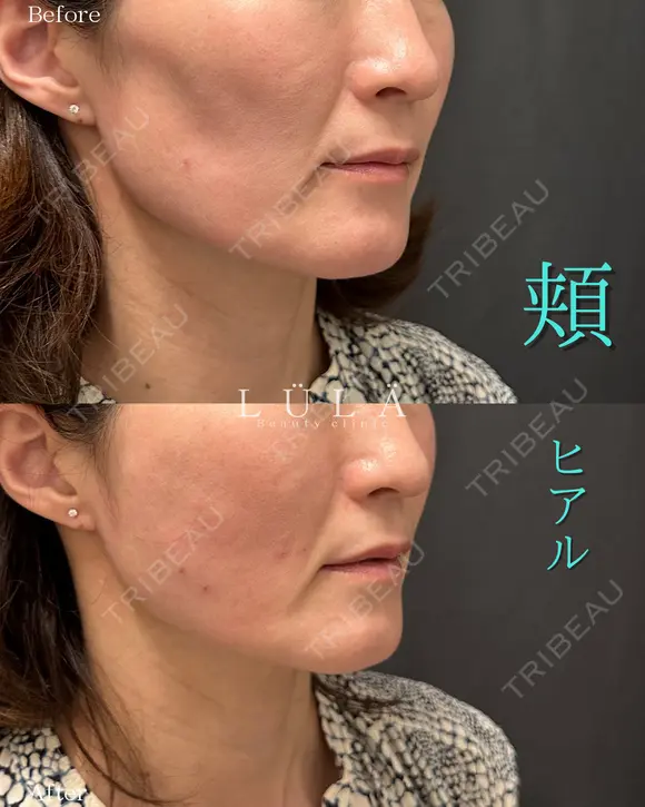 頬ヒアルロン酸 before画像 メイン用