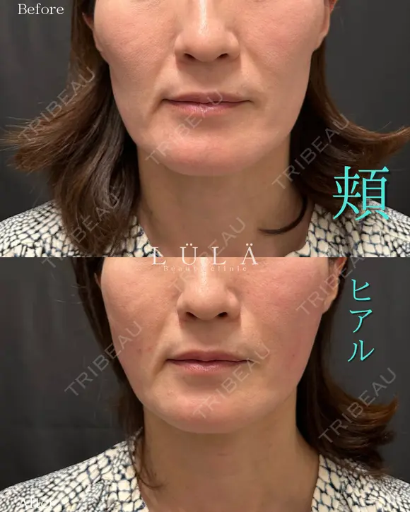 頬ヒアルロン酸 after画像 メイン用