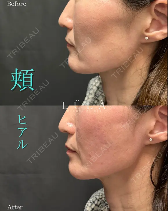 頬ヒアルロン酸 after画像 メイン用