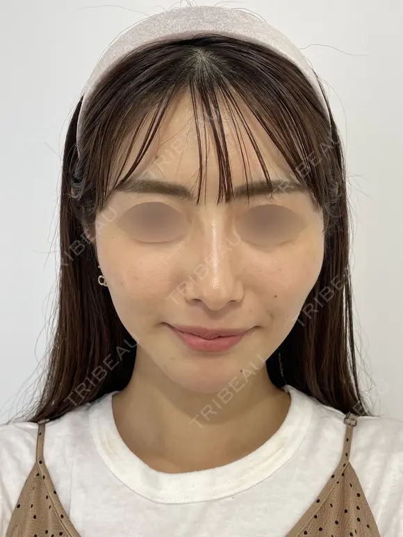 SEAライン ‐３D脂肪吸引（頬・顎）‐・糸リフト 30日後 メイン用
