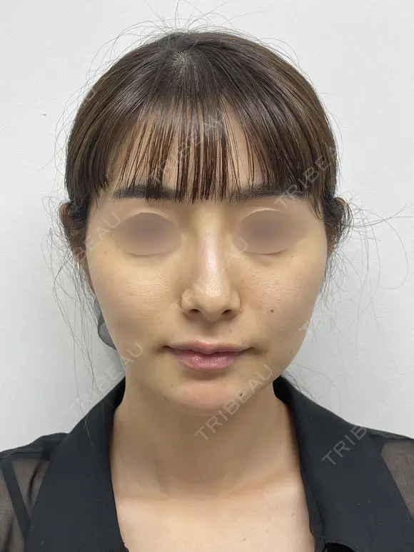 SEAライン ‐３D脂肪吸引（頬・顎）‐・糸リフト before画像 メイン用