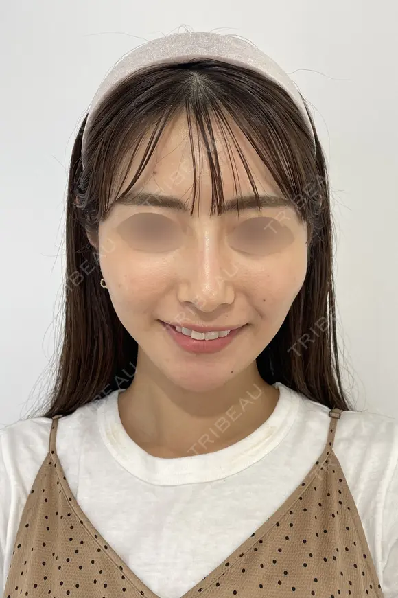 SEAライン ‐３D脂肪吸引（頬・顎）‐・糸リフト 30日後 メイン用