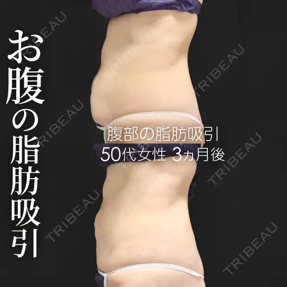 脂肪吸引（腹部） before画像 メイン用